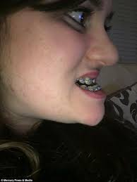 Holly Everson-Bullock has jaw realigned after underbite left her unable to  eat