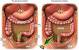 Colon Cancer Tnm Staging