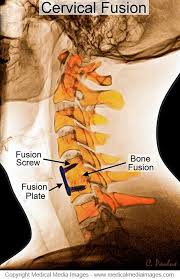 Pin On Anterior Cervical Fusion Shown On Color X Rays