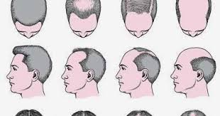 Kondisi ini bisa terjadi pada banyak orang, bukan hanya pelari saja. Pemakaian Pomade Hingga Gejala Penyakit Serius Yang Menyebabkan Kerusakan Rambut Selebx