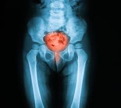 Cistite Emorragica Cause Sintomi Rimedi Dieta Pazienti It