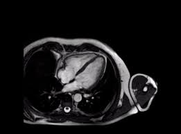 .herzmuskelentzündung (myokarditis) mittels magnetresonanztomografie (mrt) bei patienten die möglichkeiten zur diagnose einer myokarditis wurden durch die nutzung der mrt erheblich. Radiologie Sachsenhausen Kardio Mrt