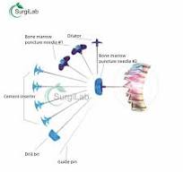 PKP KIT Kit de Vertebroplastia Relleno de Hueso Dilatador Broca Juego de  Instrumentos de Vertebroplastia Percutánea
