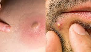 Punca sakit sendi, lutut dan cara mengubatinya. Bukan Satu Rupanya Bisul Pun Ada Ramai Adik Beradik Kalau Kena Makan Antibiotik Segera Maskulin