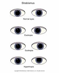 Image result for Strabismus