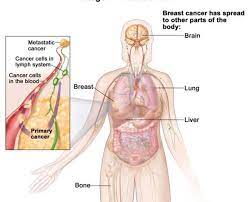 Breast cancer symptoms are important to know with it being the most common cancer in the uk. Primary Breast Tumors Put The Brakes On Metastases