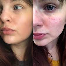 Expect differin to purge 10% each month. B A Think I Am Finally Past The Differin Purge And Feel Great With No Makeup Skincareaddiction