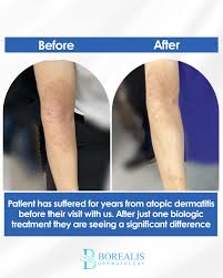 Image result for Atopic Patient