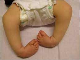 Clubfoot in babies is considered a temporary disability. Clubfeet Move And Play Paediatric Therapy