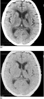 Tone în tone (t în t) calculator de transformare pentru type conversii în tabele și formule suplimentare. Digital Halftoning Algorithms For Medical Imaging Springerlink