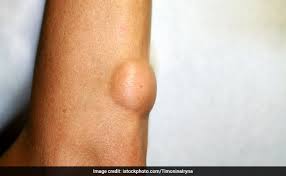 Lipomas What Are Lipomas And How To Treat Them Naturally
