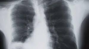 Cancerul pulmonar se traduce prin creșterea necontrolată a unor celule anormale la nivelul plămânilor. Cum PoÅ£i Depista Cancerul Pulmonar In FazÄ IncipientÄ