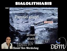 Image result for Sialolithiasis