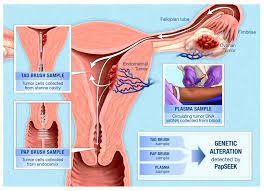 If you are diagnosed with cervical cancer, have concerns, or would like a second opinion, you can schedule an appointment with one of our gynecology specialists. Could A Pap Test Spot More Than Just Cervical Cancer