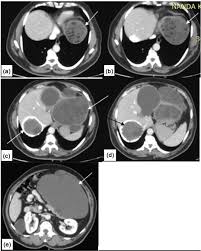 We did not find results for: Role Of Imaging In Diagnosis Predicting Biological Activity And In Treatment Plan Of Hydatid Disease