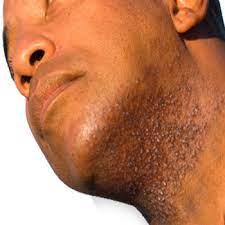 Razor bumps can be frustrating and uncomfortable. Bump Blemish Improves Appearance Of Razor Bumps Bikini Bumps And Brightens Skin