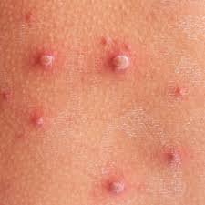 Ce inseamnă dacă ai aceste puncte pe piele ai putea suferi de dishidroză. Dureri Articulare DupÄ Varicela Varicela Cauze Simptome Trasmitere Tratament Si Prevenire Bioclinica