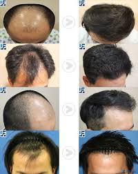 Hair Restoration Special Deal In Korea Hair Transplant Results Hair Restoration Hair Transplant
