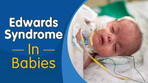 Usually human has 23 pairs of chromosomes. Edwards Syndrome In Babies Youtube