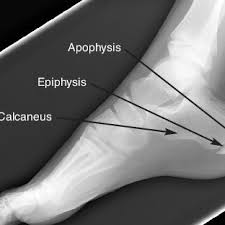 Image result for Calcaneal Apophysitis