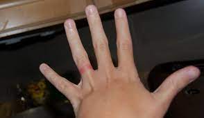 Suddenly Allergic Wedding Ring Rash Wedding Necessities Wedding Rings Simple