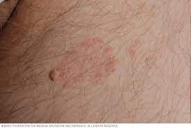 Tina Inguinal Sintomas Y Causas Mayo Clinic