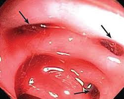 Image result for Colonoscopy in GI Bleeding