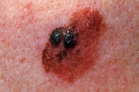 Remember that it's important to get any suspicious spots checked out your derm will do a visual exam to look for any irregular marks or moles on your skin. Stage 4 Melanoma Survival Rate Pictures And Treatment