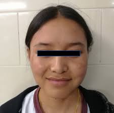 Pretreatment extraoral frontal view photograph