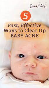 Baby Acne What Causes It How To Treat Naturally Mama Natural Baby Acne Baby Acne Remedy Newborn Acne