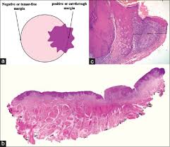 During or after breast cancer surgery, a pathologist examines tissue called the surgical margin. Postoperative Pathologic Assessment Of Surgical Margins In Oral Cancer A Contemporary Review Abstract Europe Pmc