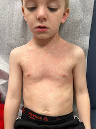 What does the keratin 5 gene mean for EBS? Can a non-EBS carrier be tested?