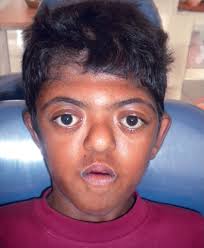 Frontal view of the face; midface hypoplasia, depression of nasal...