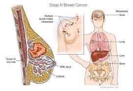 Cancer which has spread to the lymph nodes can sometimes be detected if the lymph nodes have become enlarged. Metastatic Breast Cancer Cancer Support Community