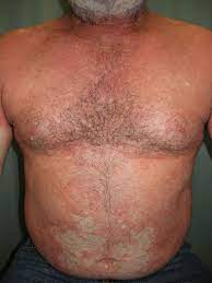 James wd, elston dm, treat jr, rosenbach ma, neuhaus im, eds. Pityriasis Rubra Pilaris Causes Signs Symptoms Diagnosis Treatment