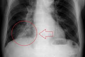 Pneumonia can be very serious in people older than 65. Aspiration Pneumonia Treatment Complications And Outlook