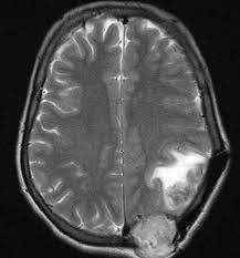 Bone metastasis incidence in these red flag signs and symptoms should prompt sm diagnosis in thyroid cancer patients. Follicular Thyroid Cancer Mri Wikidoc
