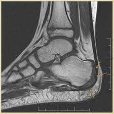 Image result for Calcaneal Apophysitis