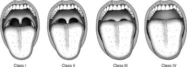 It forms the posterior pillar of the fauces or tonsillar fossa. Trauma Airway Chapter 5 Trauma