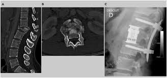 These sentences come from external sources. Prise En Charge Des Fractures A Haute Et Basse Energie Traumatique De La Colonne Thoracique Et Lombaire Revue Medicale Suisse