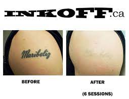 Black Tattoo Removal Before After 6 Sessions