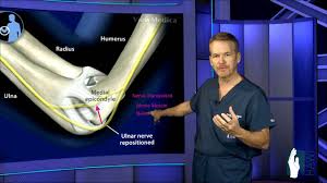 Cubital Tunnel Surgery Youtube