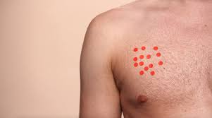 Ibc has symptoms of inflammation like swelling and redness, but infection or injury do not cause ibc or the symptoms. Coppafeel On Twitter Inflammatory Breast Cancer Is A Rare Type Of Breast Cancer Which May Cause The Skin On The Breast To Look Red Or Inflamed The Symptoms Are Caused By Cancer