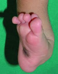 A club foot, or congenital talipes equinovarus (ctev),1 is a congenital deformity involving one foot or both.2 the affected foot appears rotated internally at the ankle. Talipes Equinovarus Clubfoot And Other Foot Abnormalities Pediatrics Msd Manual Professional Edition