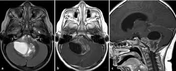 Fd Ependymoma Little Girl B Rain Darth Vader