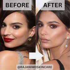 ONLY BOTOX? Only admitting to Botox? What do you think? Brow lift? Cheek  filler or implants? Buccal Fat removal? Lip filler !!! Emily Ratajkowski:  THEN AND NOW ✨ She's stunning, but is