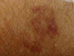 The spots may also appear on organs or mucous. Senile Purpura Causes Symptoms And Diagnosis