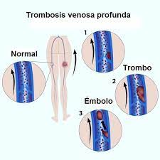 Con masaje bien fuerte, me pasa el dolor, pero con el. Trombolisis Pregnancy Solfa Syllable Trombosis Venosa Profunda Aguda De Miembros Superiores Causas De Trombosis Venosa Profunda En Miembros Superiores