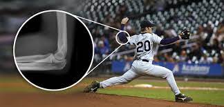 Tommy john surgery repairs the ulnar collateral ligament (ucl), the ligament that connects the humerus to the ulna. Does Tommy John Surgery Affect Pitcher Longevity Orthopedics This Week