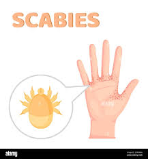 Image result for scabies transmission